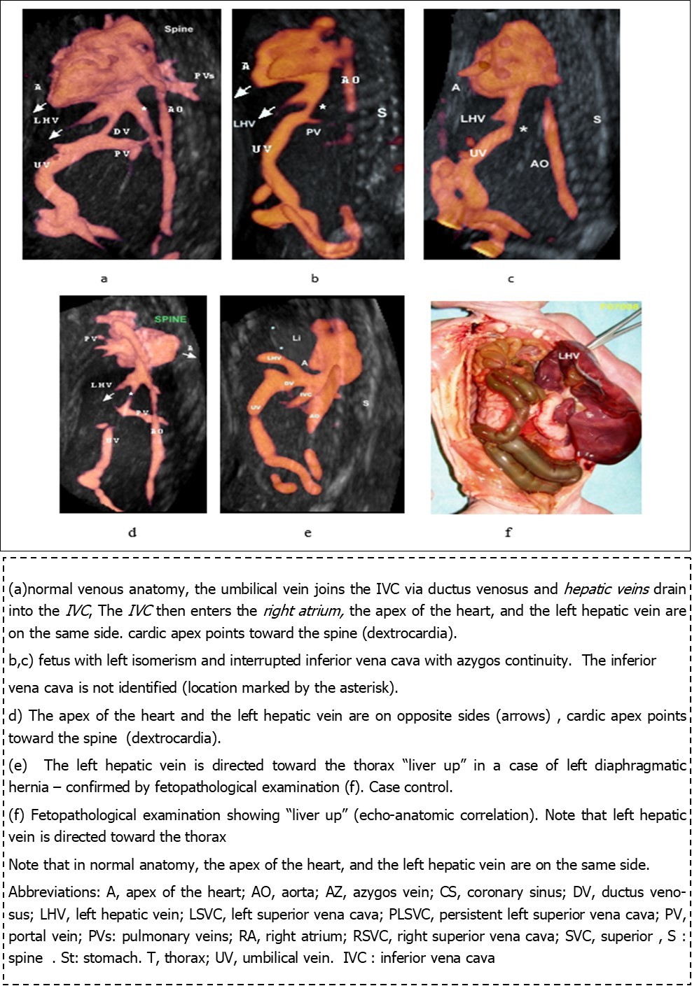Journal of Clinical Case reports and Images-Heterotaxy