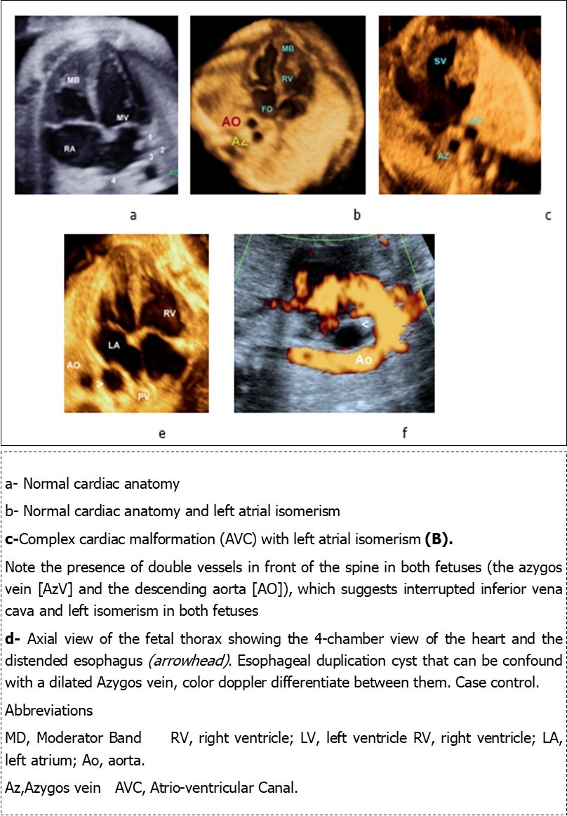 Journal of Clinical Case reports and Images-Heterotaxy