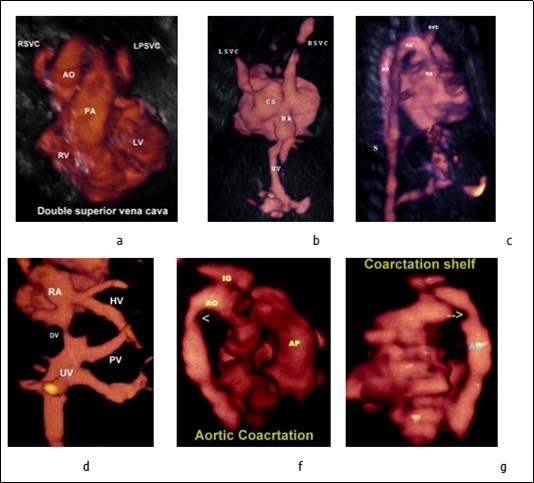 Journal of Clinical Case reports and Images-Heterotaxy