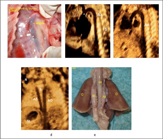 Journal of Clinical Case reports and Images-Heterotaxy