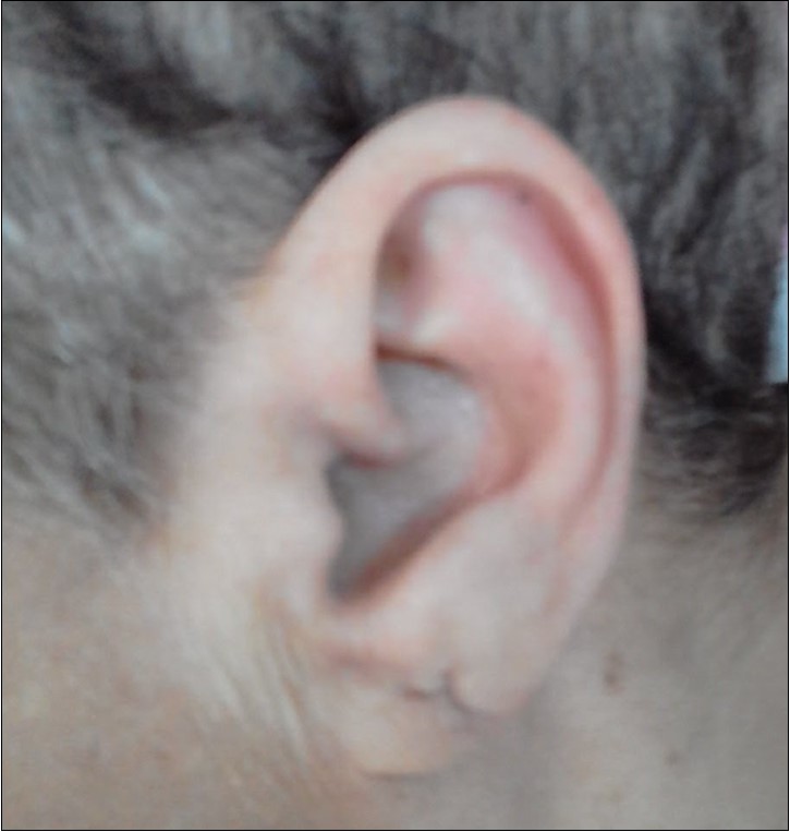 skin basal cell carcinoma