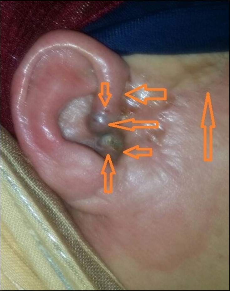 skin basal cell carcinoma