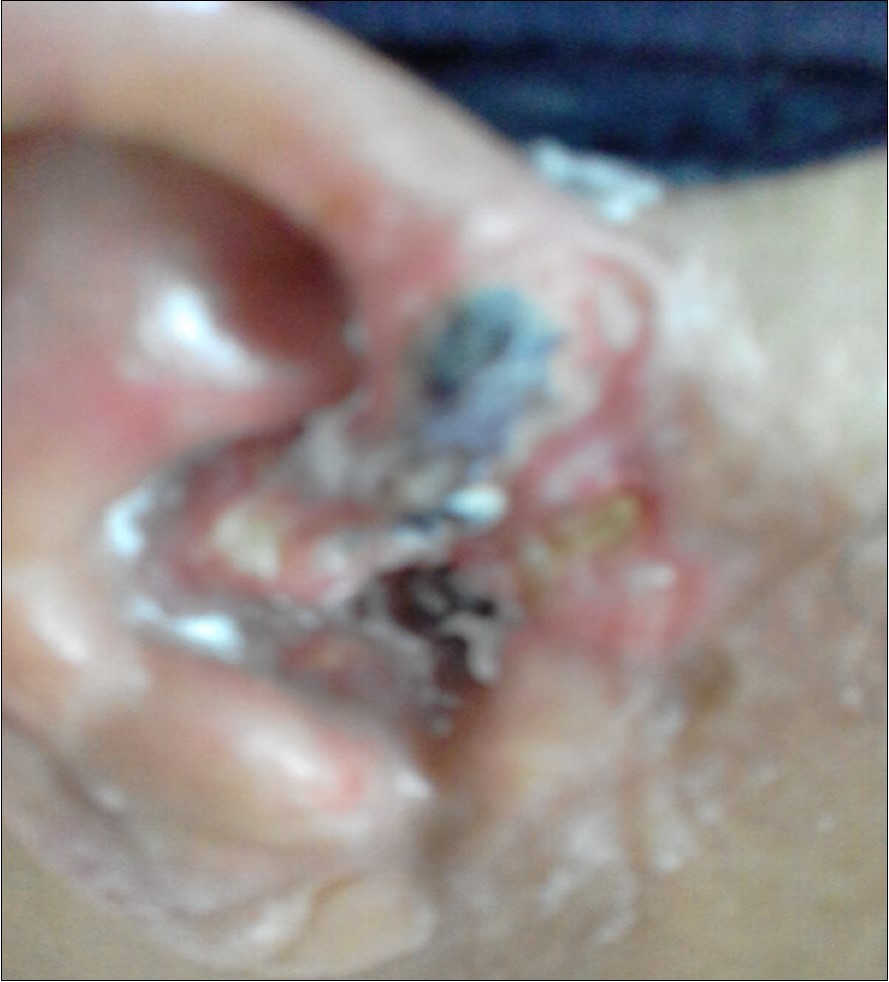 skin basal cell carcinoma