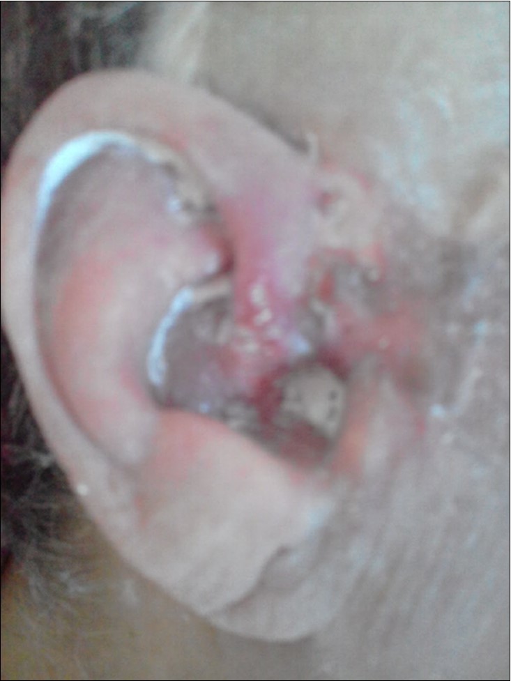 skin basal cell carcinoma