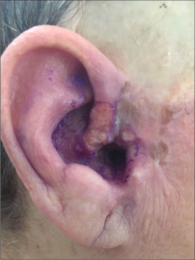 skin basal cell carcinoma