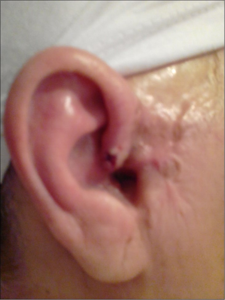 skin basal cell carcinoma