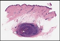 Angiomatoid fibrous histiocytoma demonstrating a multinodular pattern with circumscribing lymphoid and plasma cell infiltrate and a superimposed stratified squamous epithelium 9