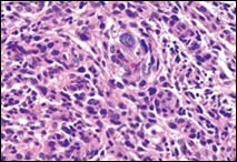 Angiomatoid fibrous histiocytoma delineating sheets of spindle-shaped cells with bland nuclei and moderate cytoplasm disseminated in a vascularized stroma and a cuff of lymphoid cells 9.