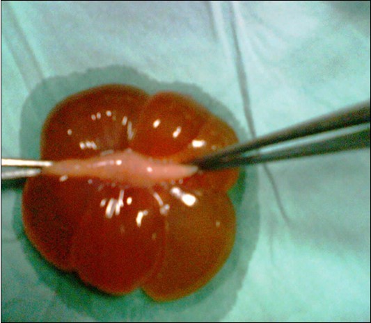 Journal of Woman's Reproductive Health-Fetal abdominal cyst