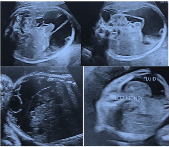 Journal of Woman's Reproductive Health-Fetal abdominal cyst