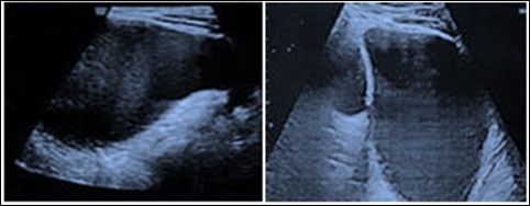 Journal of Woman's Reproductive Health-Fetal abdominal cyst