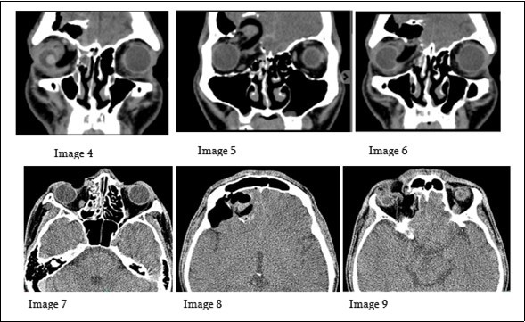 Journal of Ophthalmic Science-Orbitocranial penetrating injury