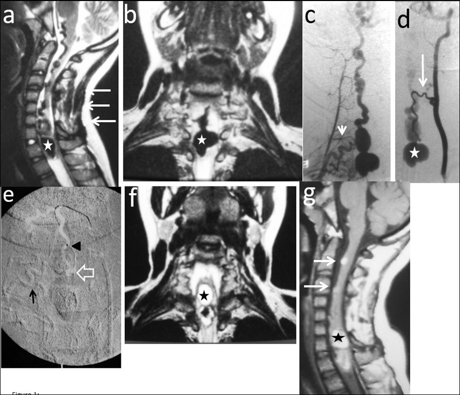 Journal of Neurological Research And Therapy-Perimedullary