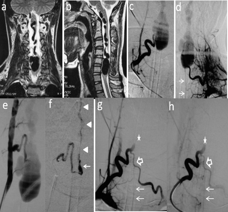 Journal of Neurological Research And Therapy-Perimedullary