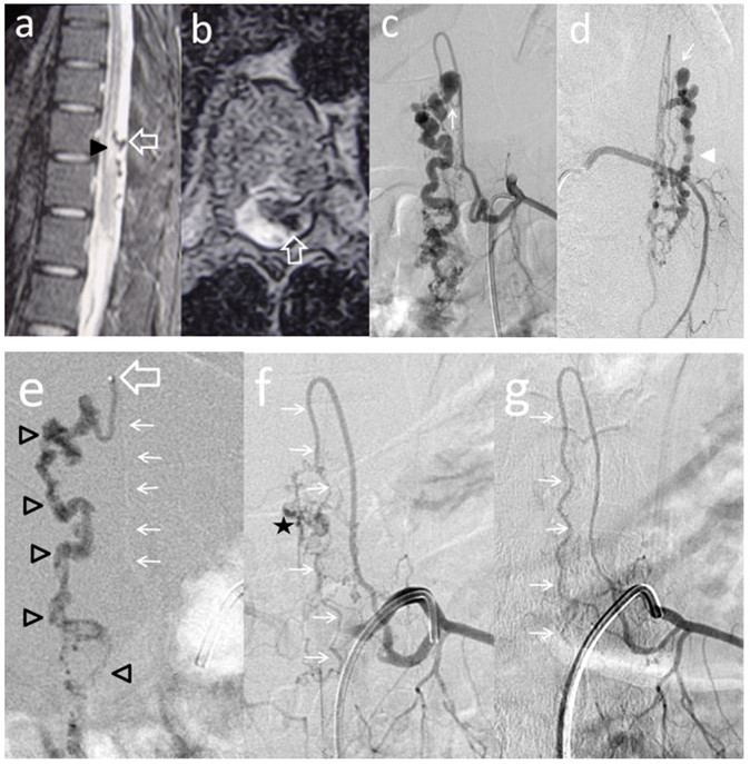 Journal of Neurological Research And Therapy-Perimedullary
