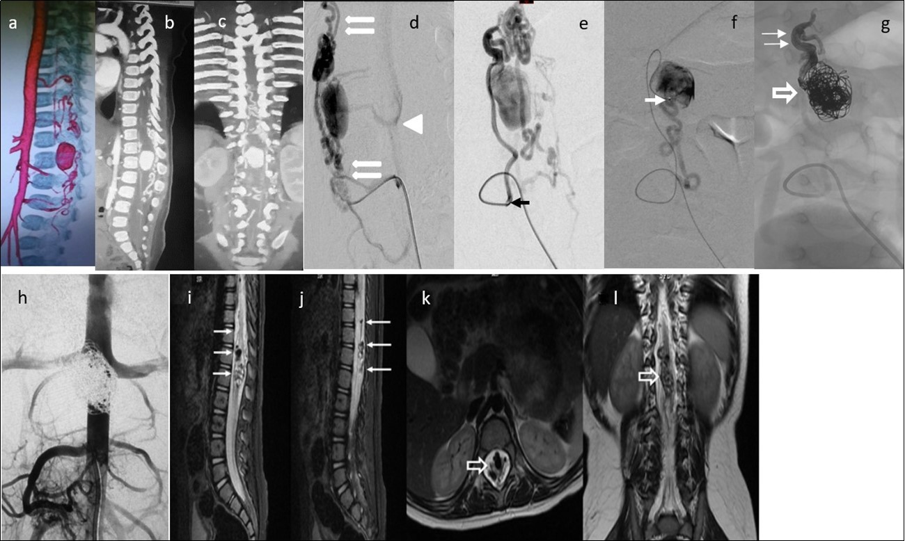 Journal of Neurological Research And Therapy-Perimedullary