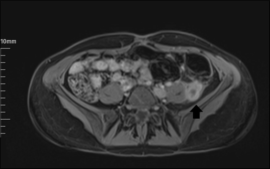Journal of Clinical Case reports and Images-Deep vein thrombosis