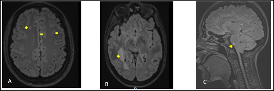 Journal of Neurological Research And Therapy-ADEM