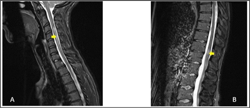 Journal of Neurological Research And Therapy-ADEM