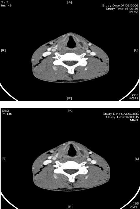 Journal of Otolaryngology Advances-Fibrous dysplasia