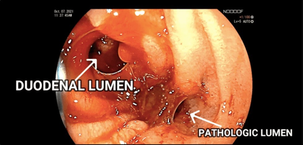 Journal of Clinical Case reports and Images-Benign Duodenocolic Fistula