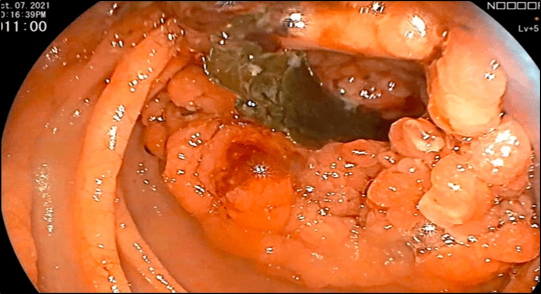 Journal of Clinical Case reports and Images-Benign Duodenocolic Fistula