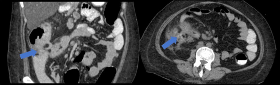 Journal of Clinical Case reports and Images-Benign Duodenocolic Fistula