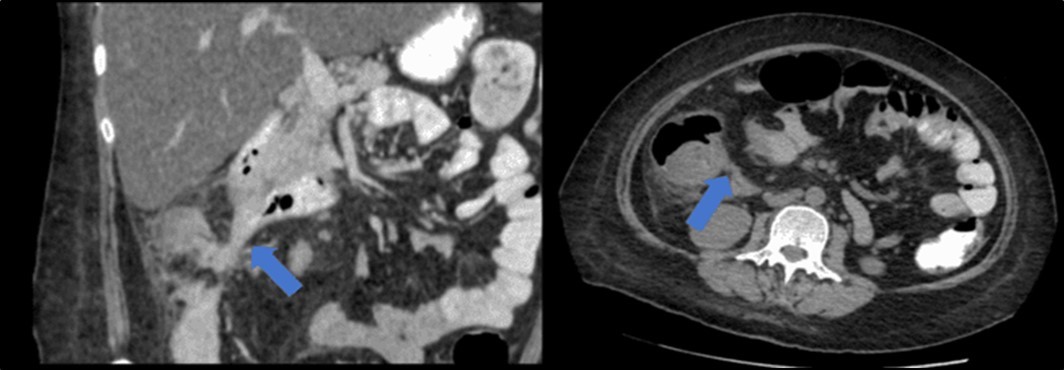 Journal of Clinical Case reports and Images-Benign Duodenocolic Fistula