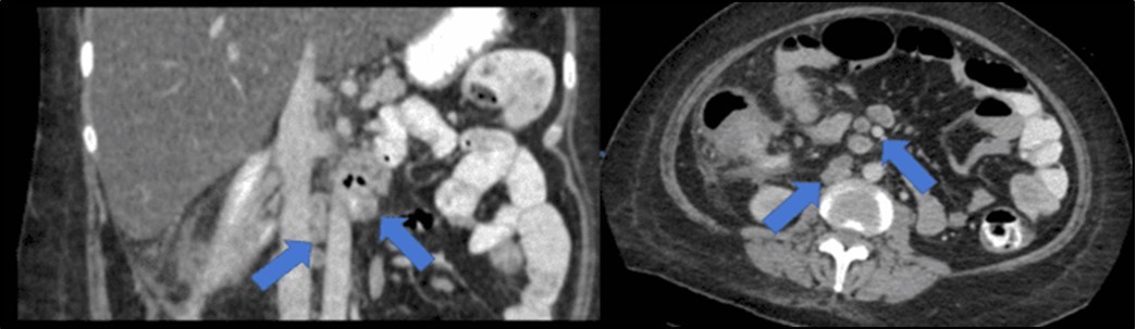Journal of Clinical Case reports and Images-Benign Duodenocolic Fistula