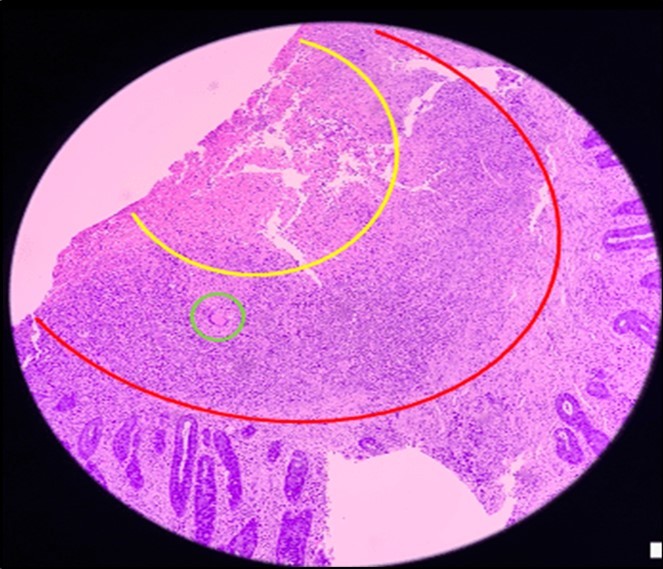 Journal of Clinical Case reports and Images-Benign Duodenocolic Fistula