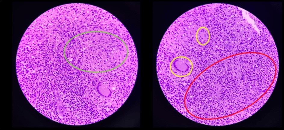 Journal of Clinical Case reports and Images-Benign Duodenocolic Fistula
