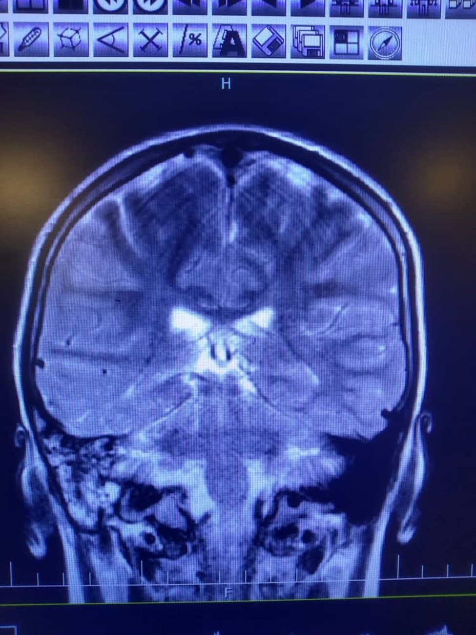 Journal of Diseases-bacterial meningitis