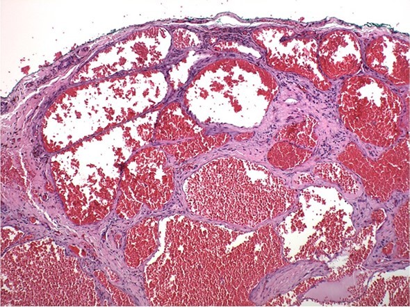 Histopathology of cavernous hemangioma. Note irregular sinusoids lined by endothelium containing erythrocytes. Hematoxylin and eosin, 400x.