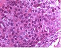 Chondroblastoma demonstrating round to oval chondroblastic cells with abundant, eosinophilic cytoplasm and vesicular grooved nuclei encompassed within a myxochondroid matrix5.