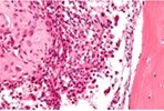 Chondroblastoma delineating aggregates of polyhedral chondroblastic cells with angulated, abundant, eosinophilic cytoplasm and vesicular nuclei enmeshed within a chondomyxomatous matrix6.