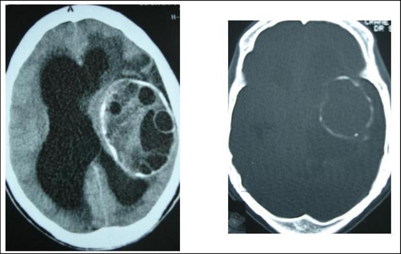 Journal of Neurological Research And Therapy-Ecchynococcus granulosis