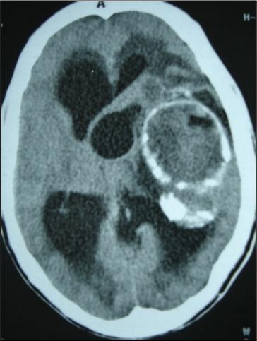 Journal of Neurological Research And Therapy-Ecchynococcus granulosis