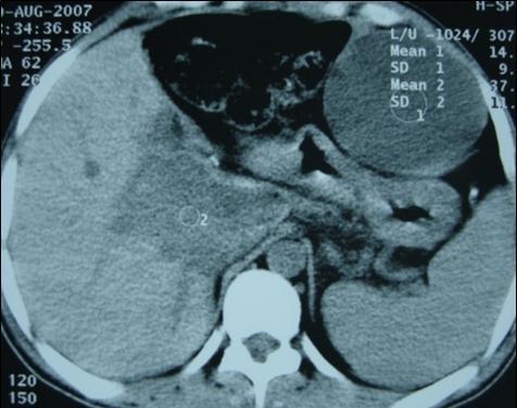 Journal of Neurological Research And Therapy-Ecchynococcus granulosis