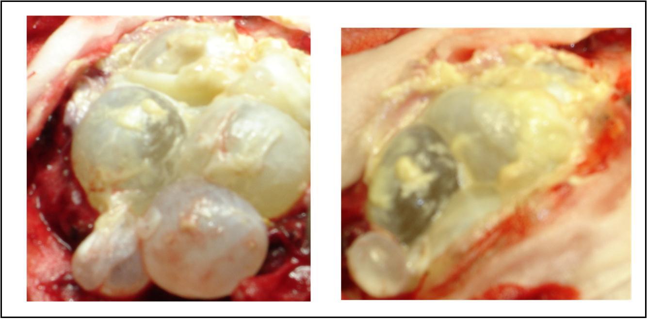 Journal of Neurological Research And Therapy-Ecchynococcus granulosis