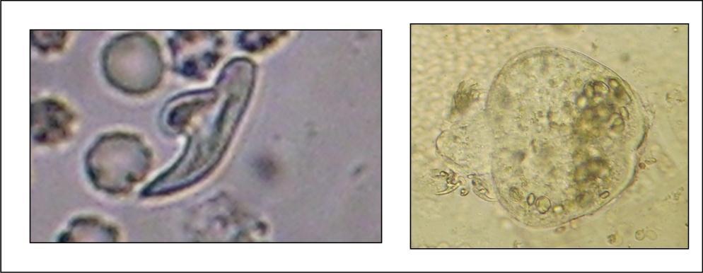 Journal of Neurological Research And Therapy-Ecchynococcus granulosis