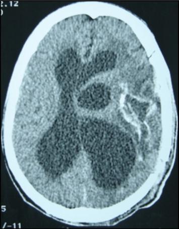 Journal of Neurological Research And Therapy-Ecchynococcus granulosis