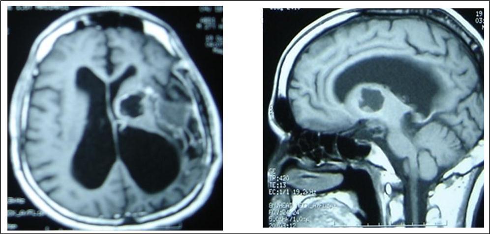 Journal of Neurological Research And Therapy-Ecchynococcus granulosis