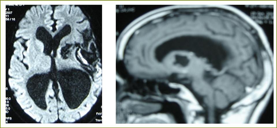 Journal of Neurological Research And Therapy-Ecchynococcus granulosis