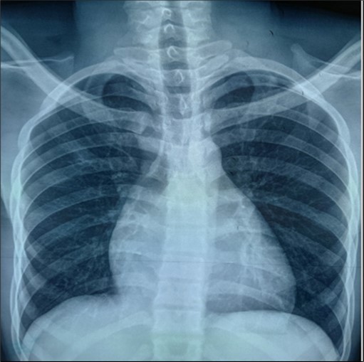 Frontal chest radiograph showing cardiomegaly