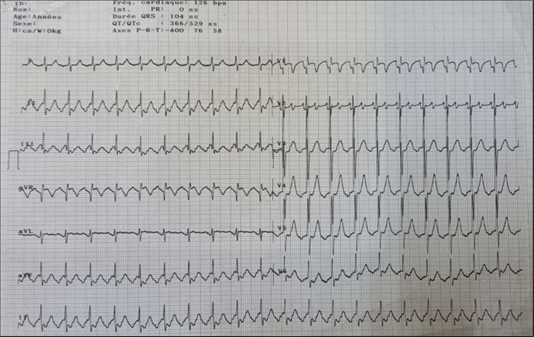 EKG