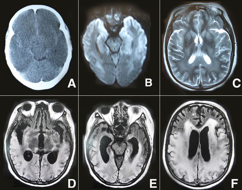 Journal of Neurological Research and Therapy-cardiorespiratory arrest