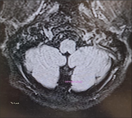 Transverse section of brain MRI (T2 Flair) showing absence of cerebellar edema.