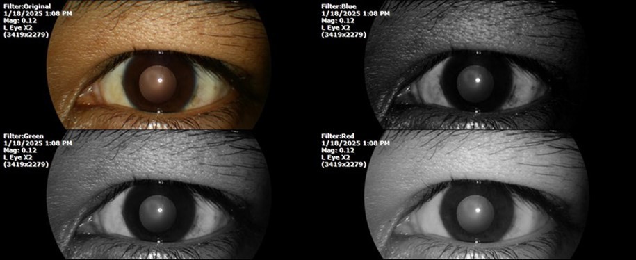 Journal of Aging Research and Healthcare - Berlin´s edema