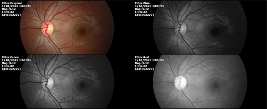 Journal of Aging Research and Healthcare - Berlin´s edema