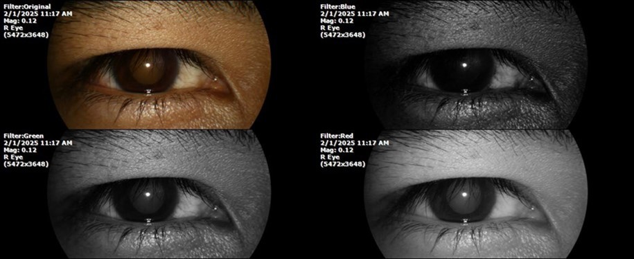 Journal of Aging Research and Healthcare - Berlin´s edema